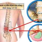 Kỹ thuật phục hồi chức năng thoát vị đĩa đệm cột sống thắt lưng