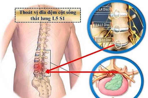 Kỹ thuật phục hồi chức năng thoát vị đĩa đệm cột sống thắt lưng
